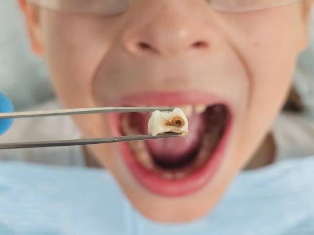 Best Emergency Dentist for Knocked-Out Tooth in Wellsville, KS