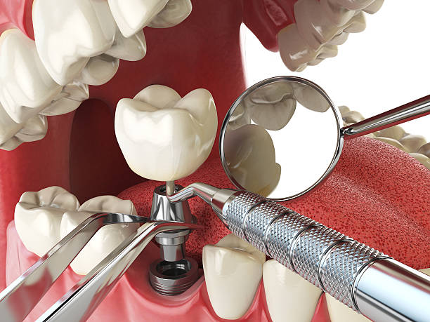 Best Emergency Dentist for Lost Fillings or Crowns in Wellsville, KS